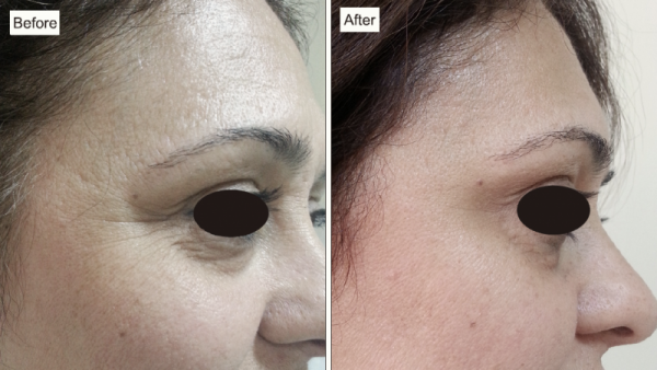 Platelet-Rich Plasma (PRP) 1 Platelet-Rich Plasma (PRP) - 1