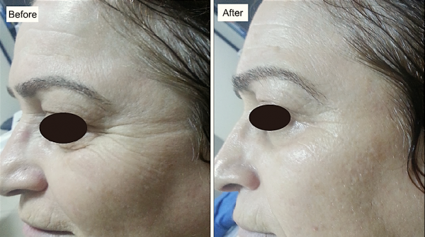 Platelet-Rich Plasma (PRP) 2 Platelet-Rich Plasma (PRP) - 2