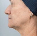 Face surgery procedures at The Layt Clinic, sample 1, before