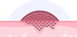 Skin-Lesions-Skin-Cancer