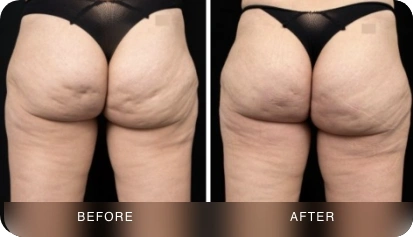 Cellulite reduction before and after