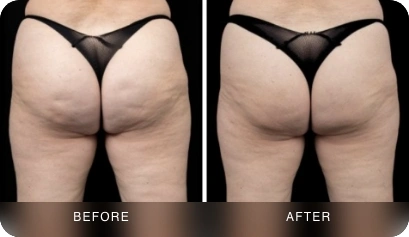 Cellulite reduction before and after
