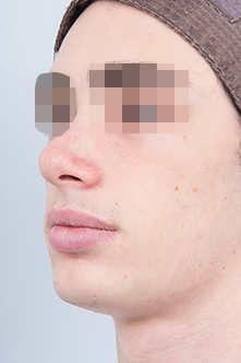 before image